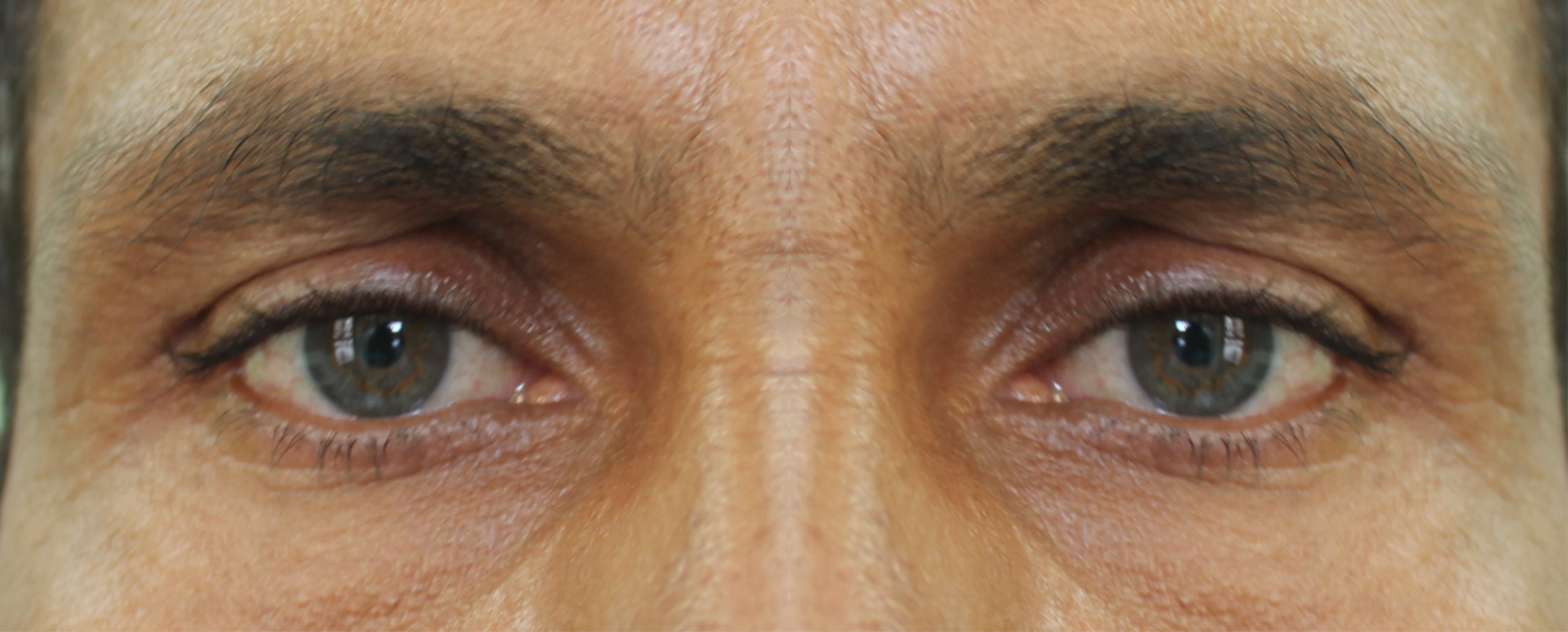 artificial eye Centre Delhi India